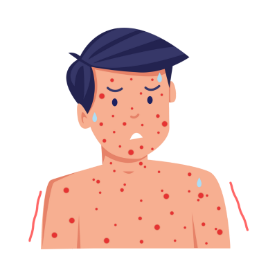 Chickenpox Vaccine