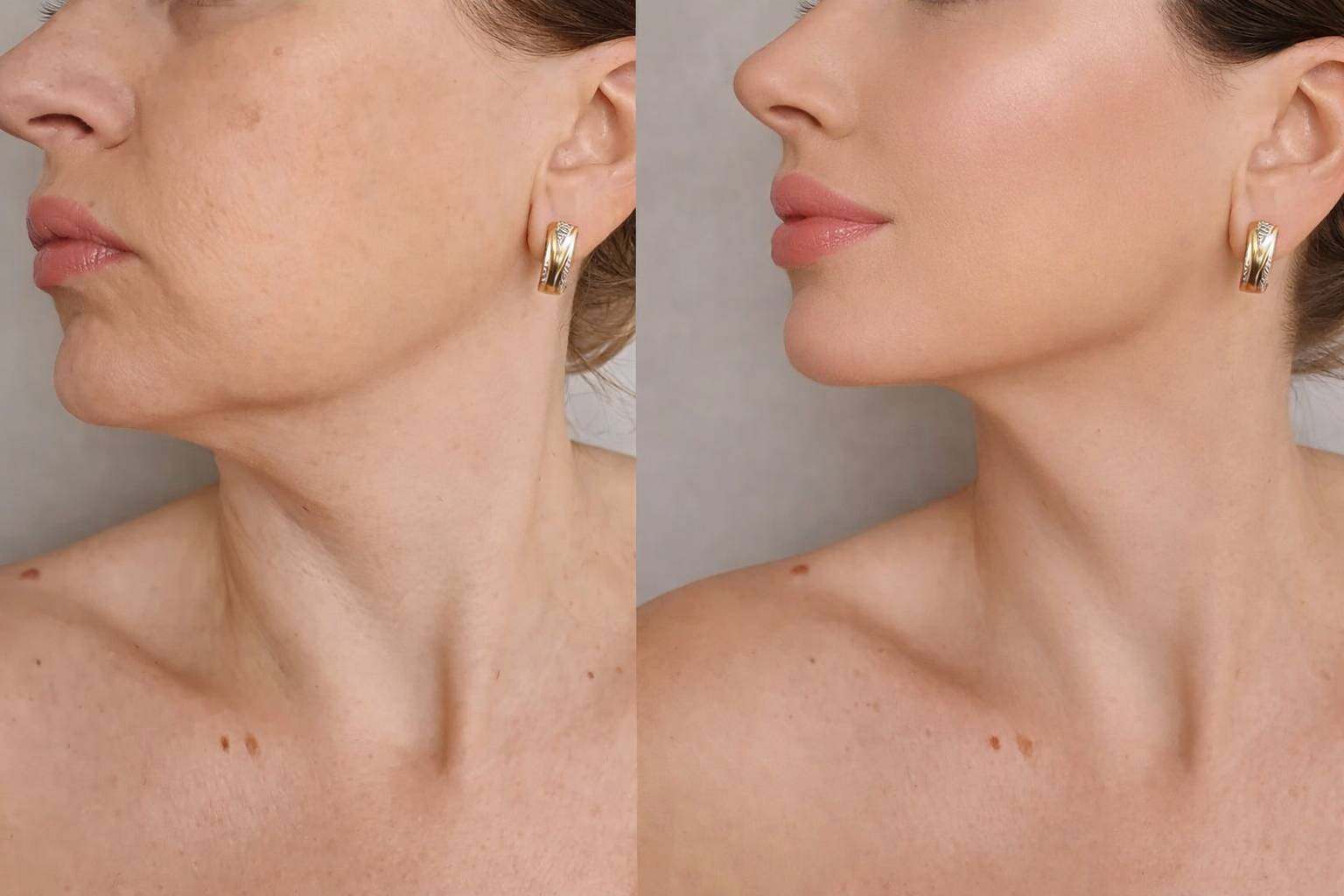 Fat Dissolving Injections